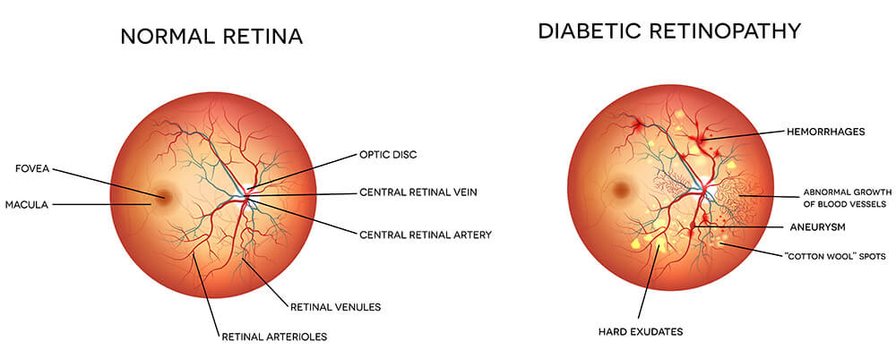 Chart Illustrating a Normal Retina vs One With Diabetic Retinopathy
